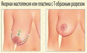 Якорная мастопексия или пластика груди с Т-образным разрезом